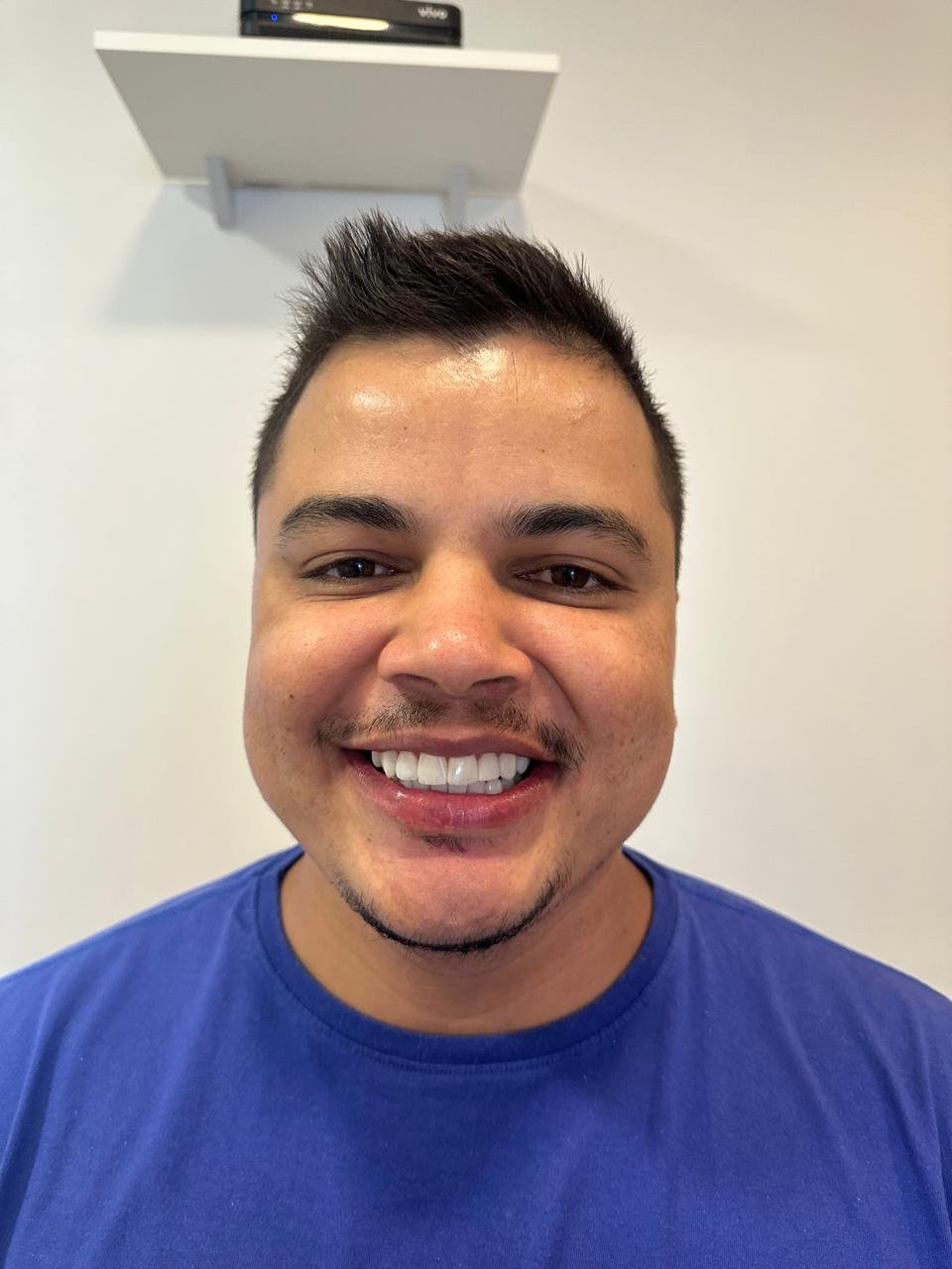 Facetas em resina - registro 2