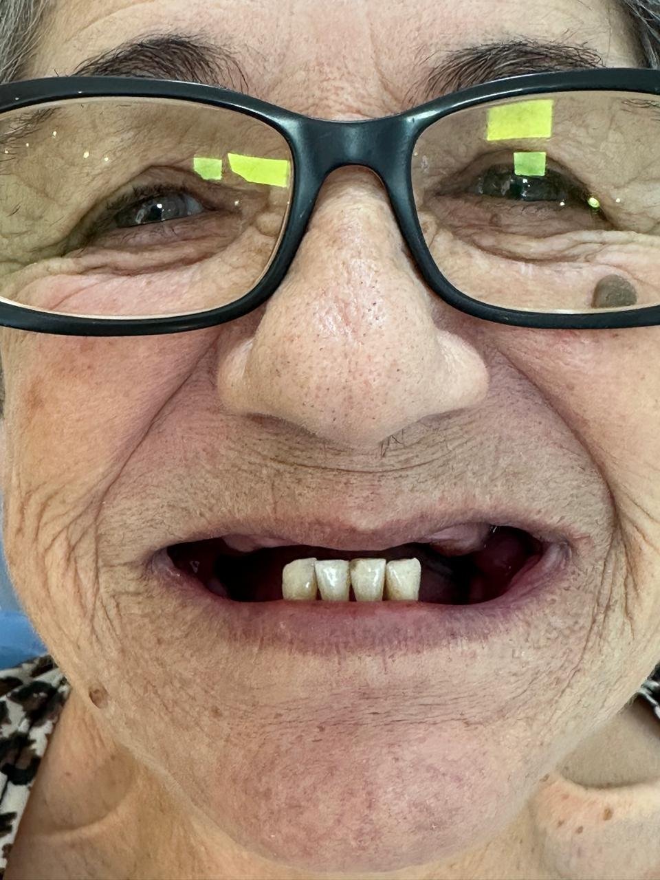 Prótese dentária - registro 1